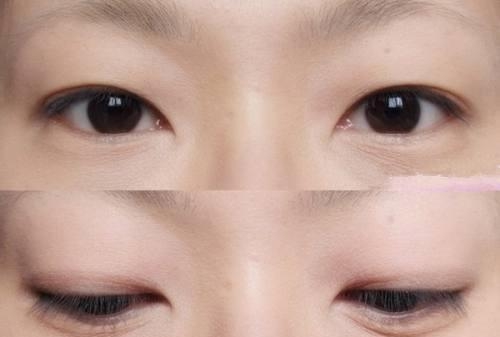 單眼皮怎么變雙眼皮