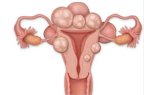 子宮肌瘤是什么原因導致的
