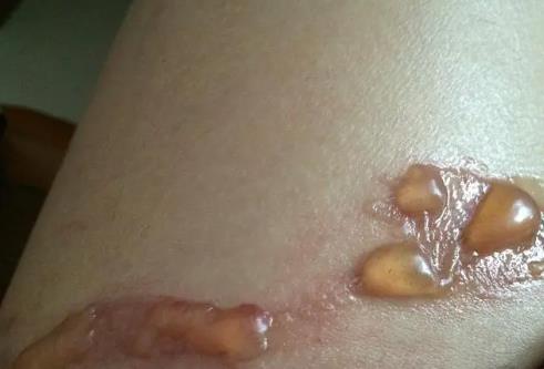 燙傷了該怎么辦