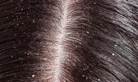 頭皮屑多如何去除小妙招