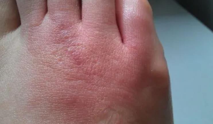 被螞蟻咬后又紅又腫又癢怎么辦