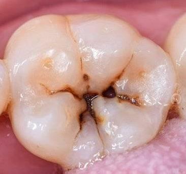 蛀牙如何讓它停止腐蝕