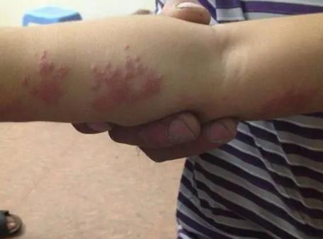 皰疹是因為什么原因引起的