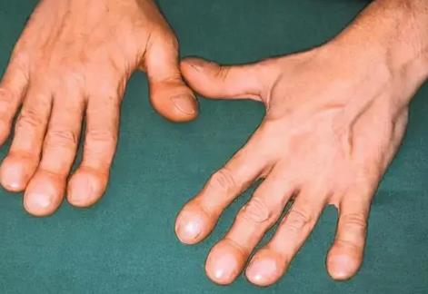 手指關(guān)節(jié)疼痛腫脹怎么辦