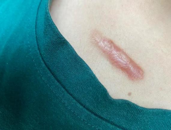 疤痕增生如何消除