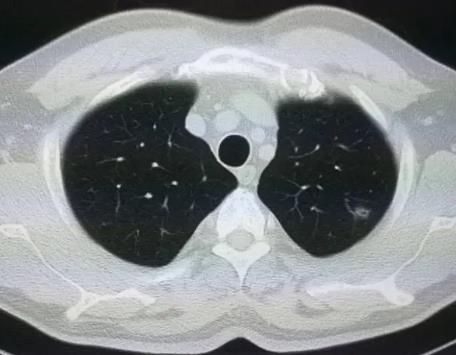為什么CT很多人有肺部小結節