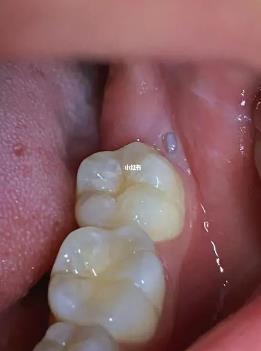 為什么會長智齒