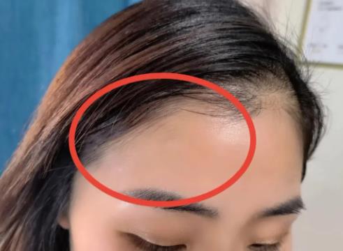 發際線怎么修