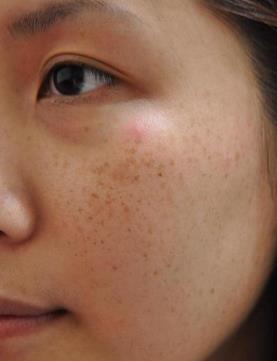 臉上有斑點怎么辦