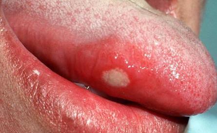 舌頭上潰瘍怎么治