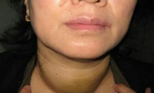 甲亢怎么治療最好最快 甲亢怎么治療最好最快