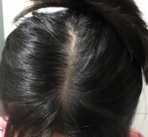 頭發掉的太嚴重怎么解決 頭發掉的太嚴重怎么解決