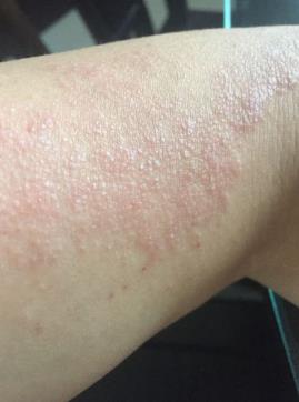 紫外線過敏怎么解決