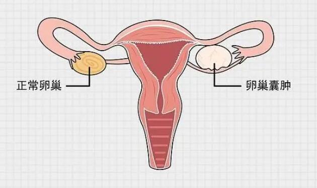 卵巢囊腫是怎么來的