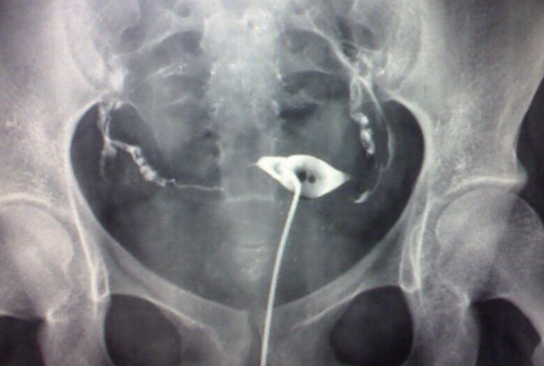 輸卵管造影檢查是怎么做的 輸卵管造影檢查是怎么做的