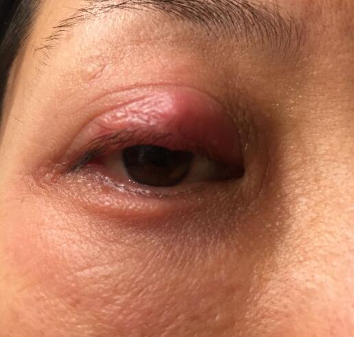 眼睛腫了如何快速消除 眼睛腫了如何快速消除