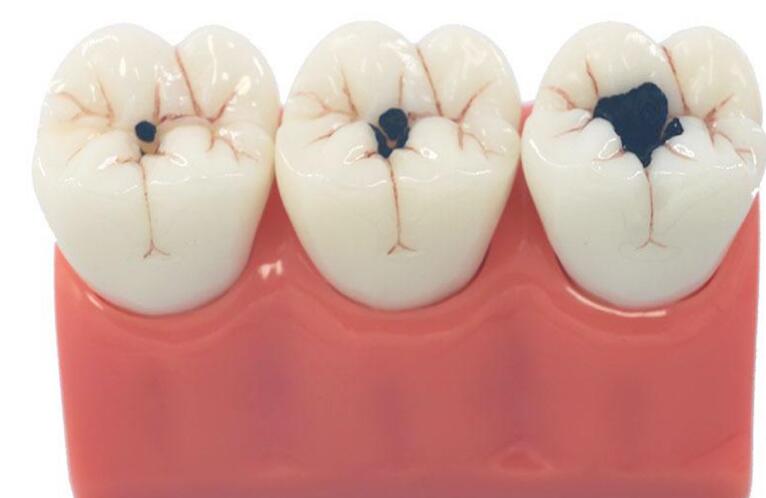 蛀牙如何讓它停止腐蝕