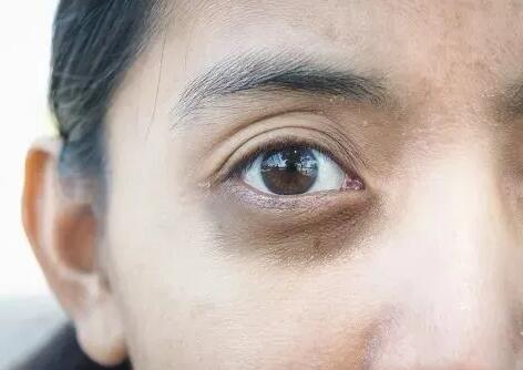 如何去除黑眼圈