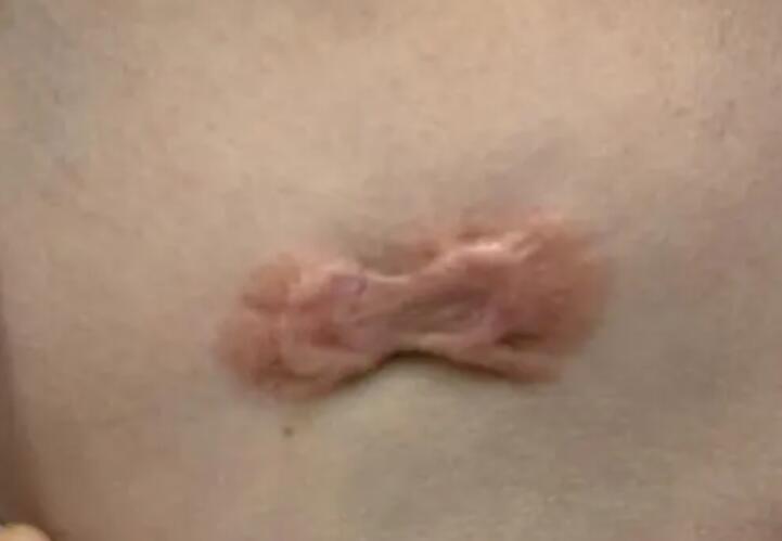 疤痕增生如何消除