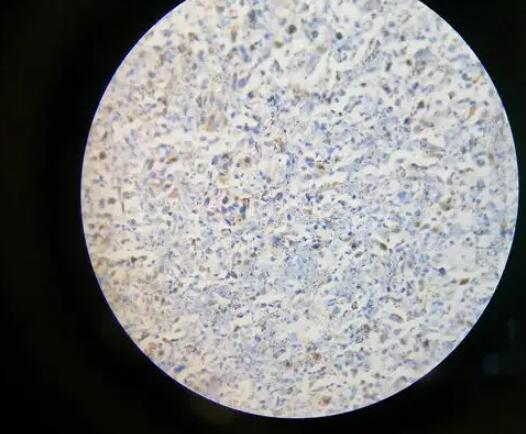怎么看免疫組化結果 怎么看免疫組化結果