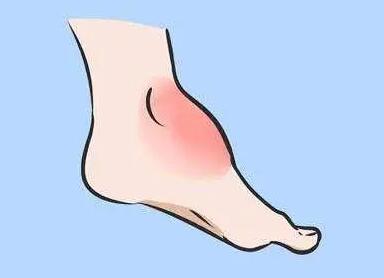 摔傷后怎么消腫化瘀