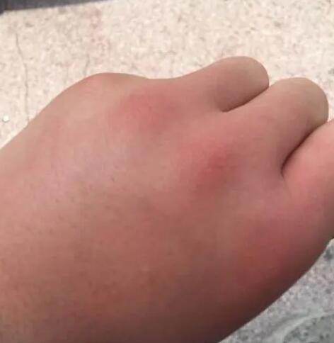 被蜜蜂蟄了怎么消腫
