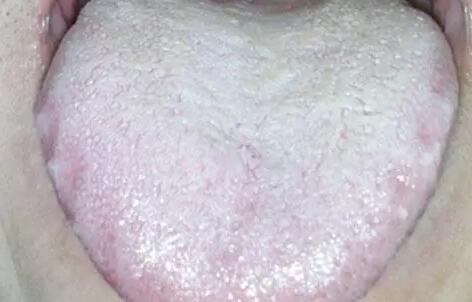 舌苔厚白是怎么回事