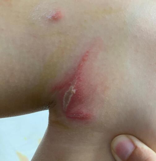 被隱翅蟲咬了怎么辦？