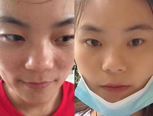 有什么方法祛斑