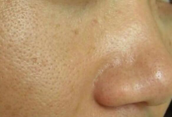 毛孔粗大怎么辦怎么收縮毛孔