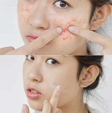 祛痘有什么方法