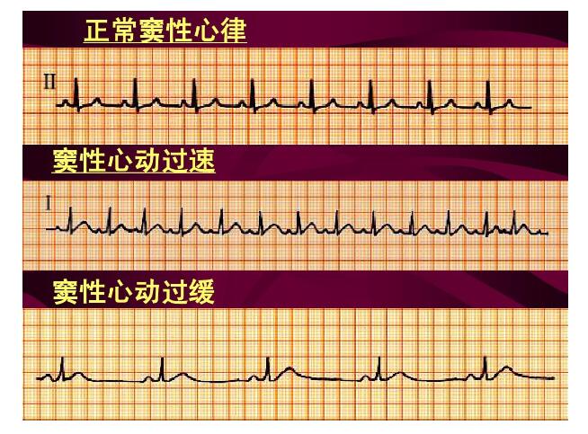 竇性心律是健康的嗎？
