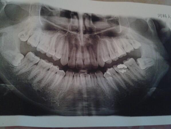 智齒牙齦發炎腫痛怎么辦