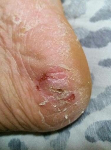 腳后跟干裂起硬皮裂口子怎么辦