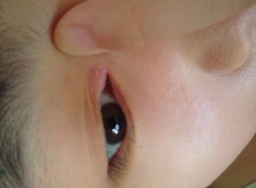 眼角發癢是什么原因?眼角發癢的5大原因 眼角發癢是什么原因?眼角發癢的5大原因