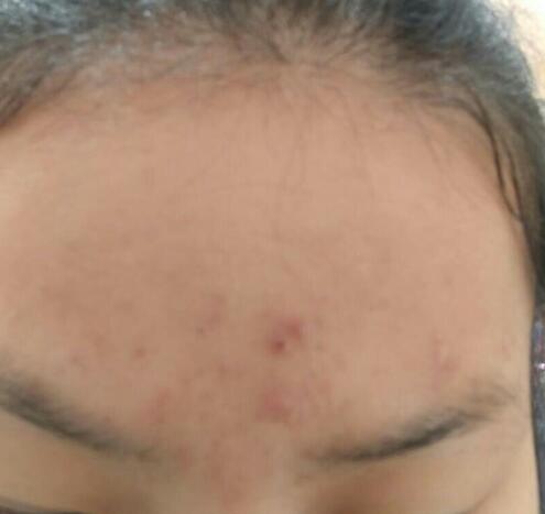 眉心長痘痘什么原因？
