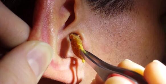 耳朵里面發癢是什么原因