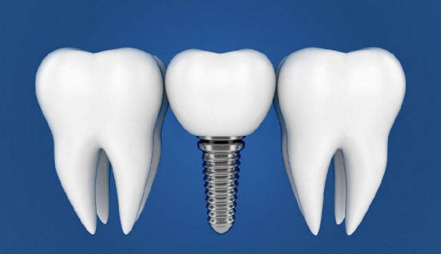 種植牙多少錢一顆？