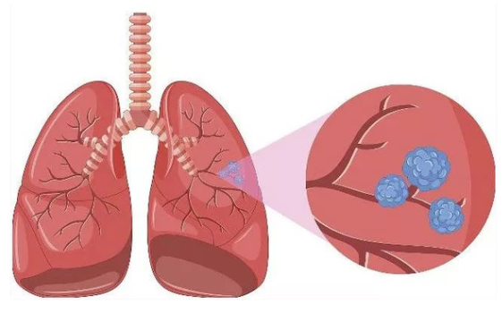 結(jié)節(jié)是一種什么病